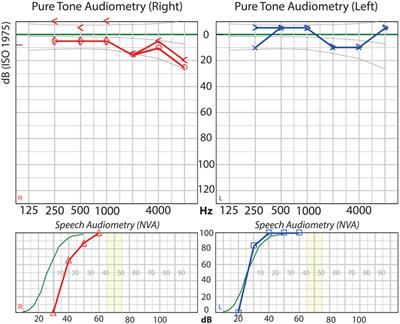 The Vestibular Implant: Hearing Preservation during Intralabyrinthine Electrode Insertion—A Case Report